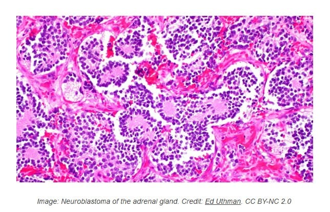 RedHill Receives FDA Orphan Drug Designation for Neuroblastoma Treatment